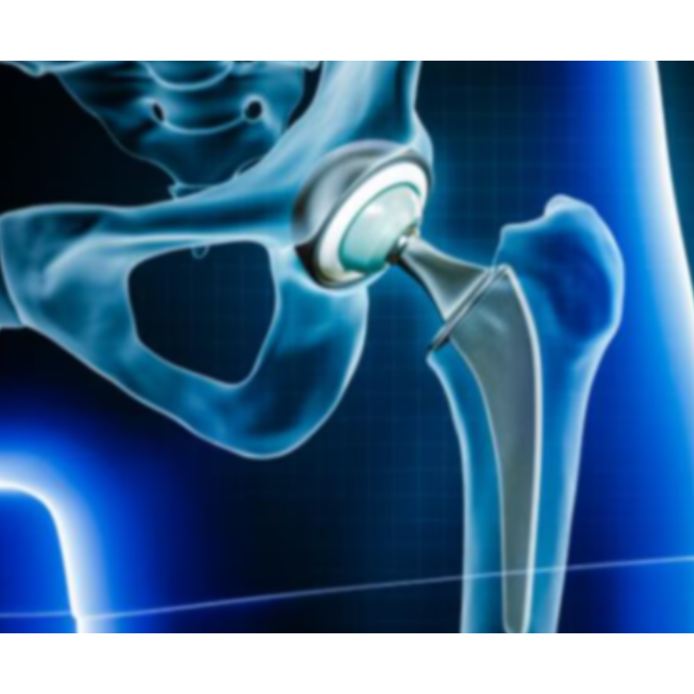 Hip Replacement Surgery in Chennai – Regain Moveme... main image