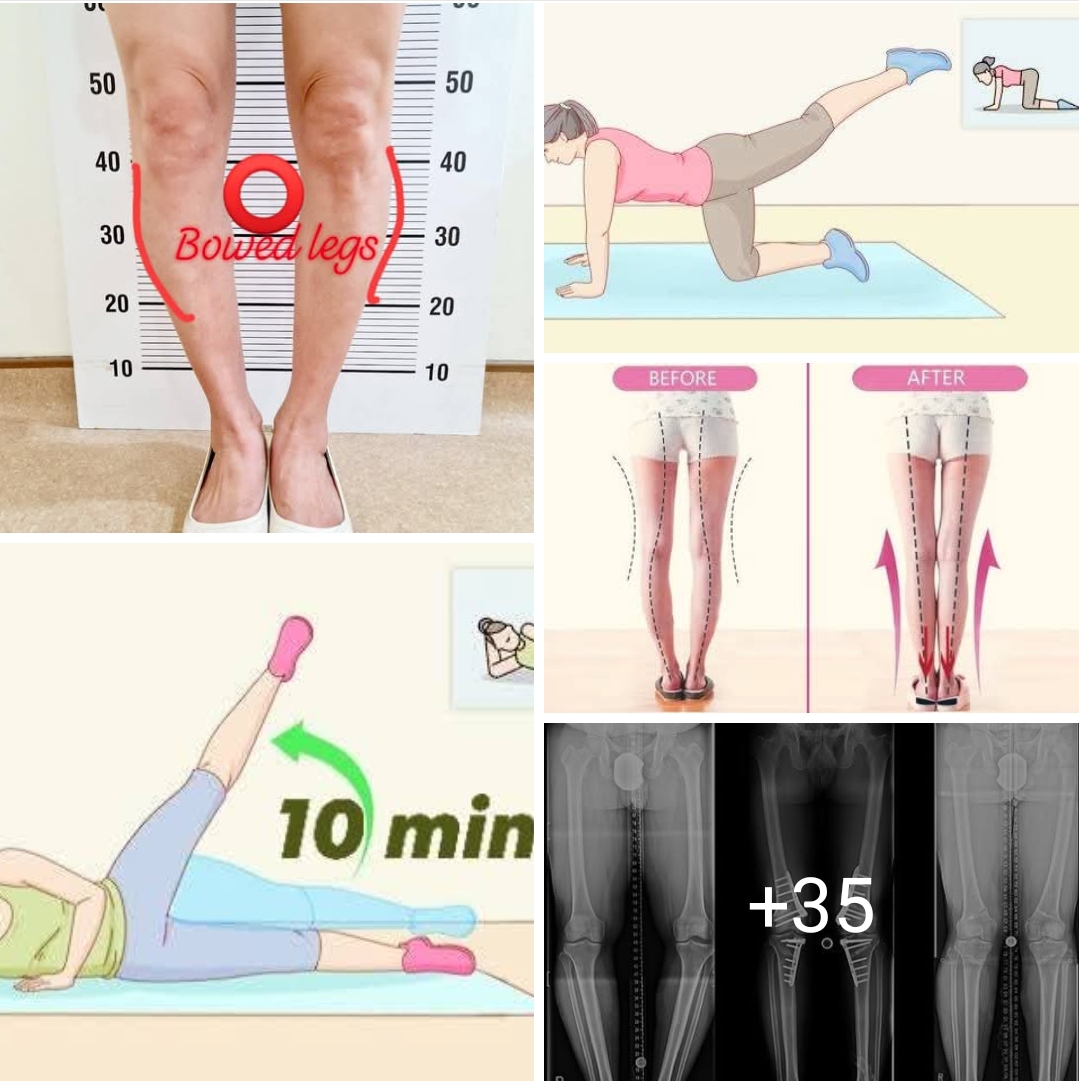 #Bowed_Leg in adult Bowlegs in adults, also kno... main image