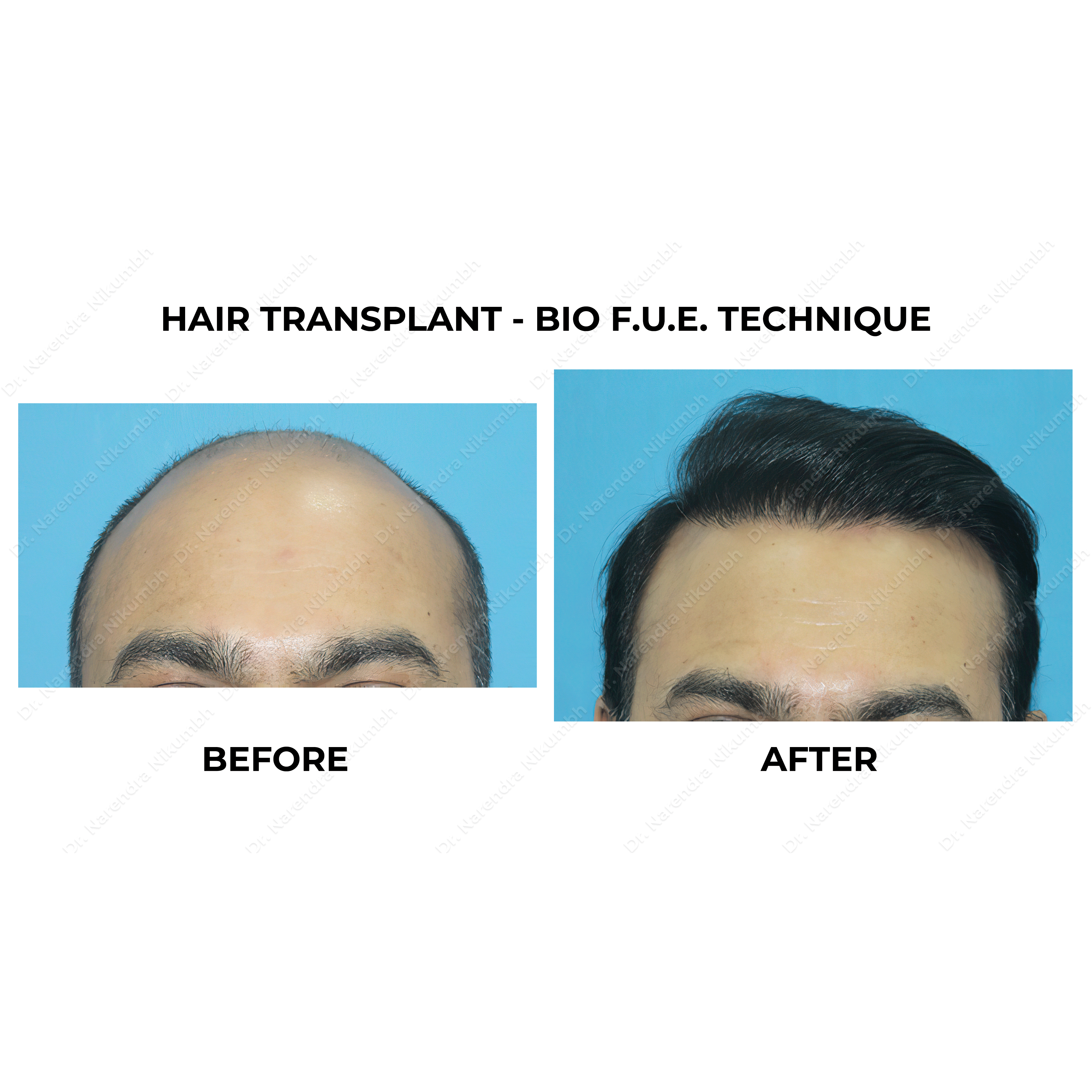 Dr. Narendra Nikumbh: Thane’s Best Hair Transpl... main image