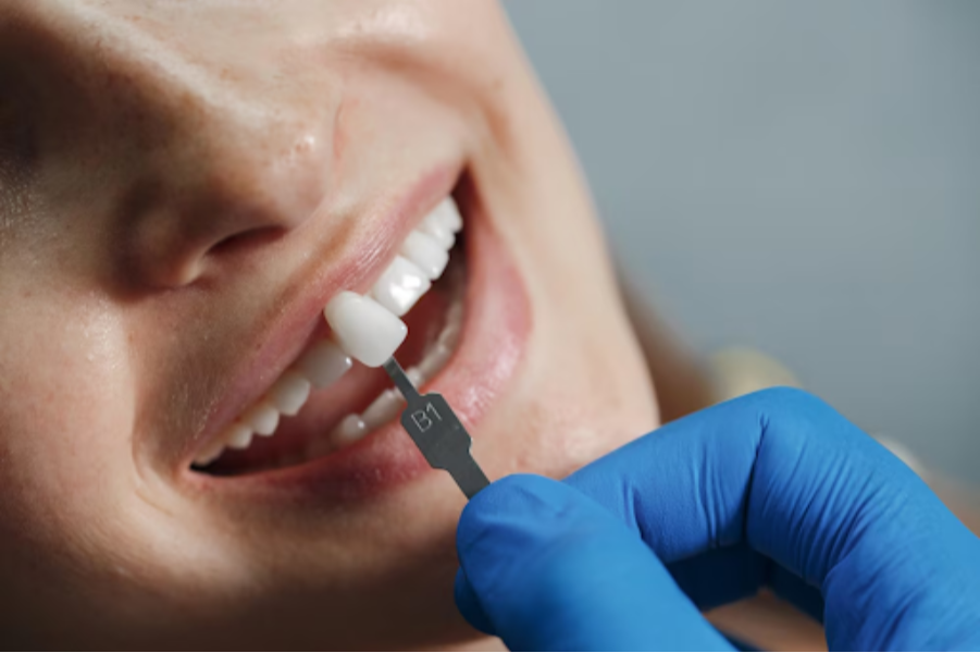 Dental Veneers in Delhi – A Quick Way to a Flaw... main image