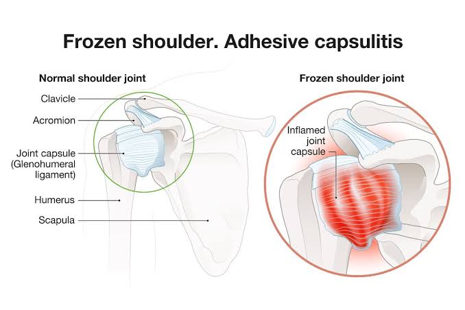 Frozen Shoulder : also known as adhesive capsul... main image