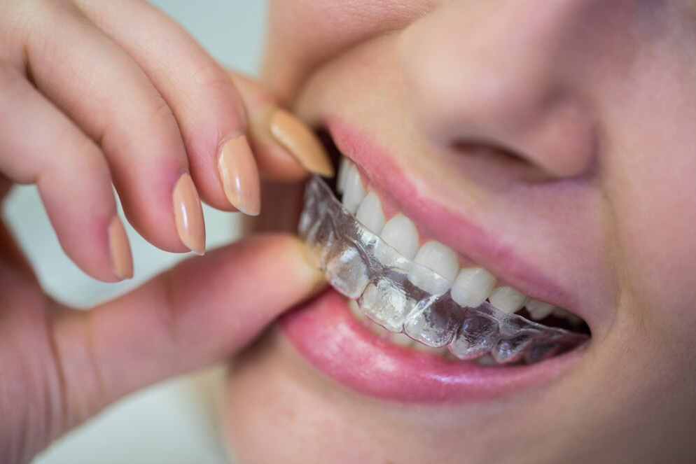 Invisible Braces – Clear Solution for Teeth Str... main image