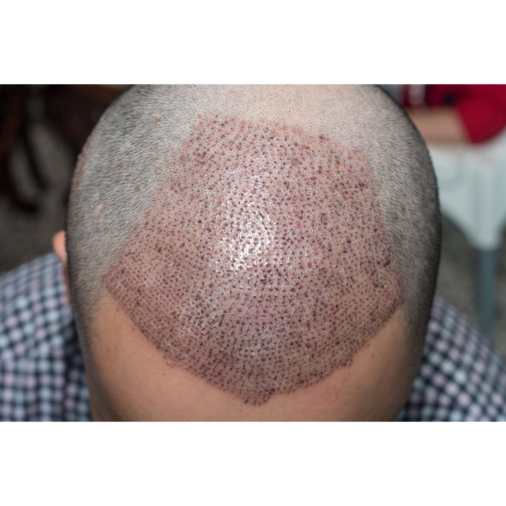 Pre-Surgery Counseling: Key to Successful Hair ... main image