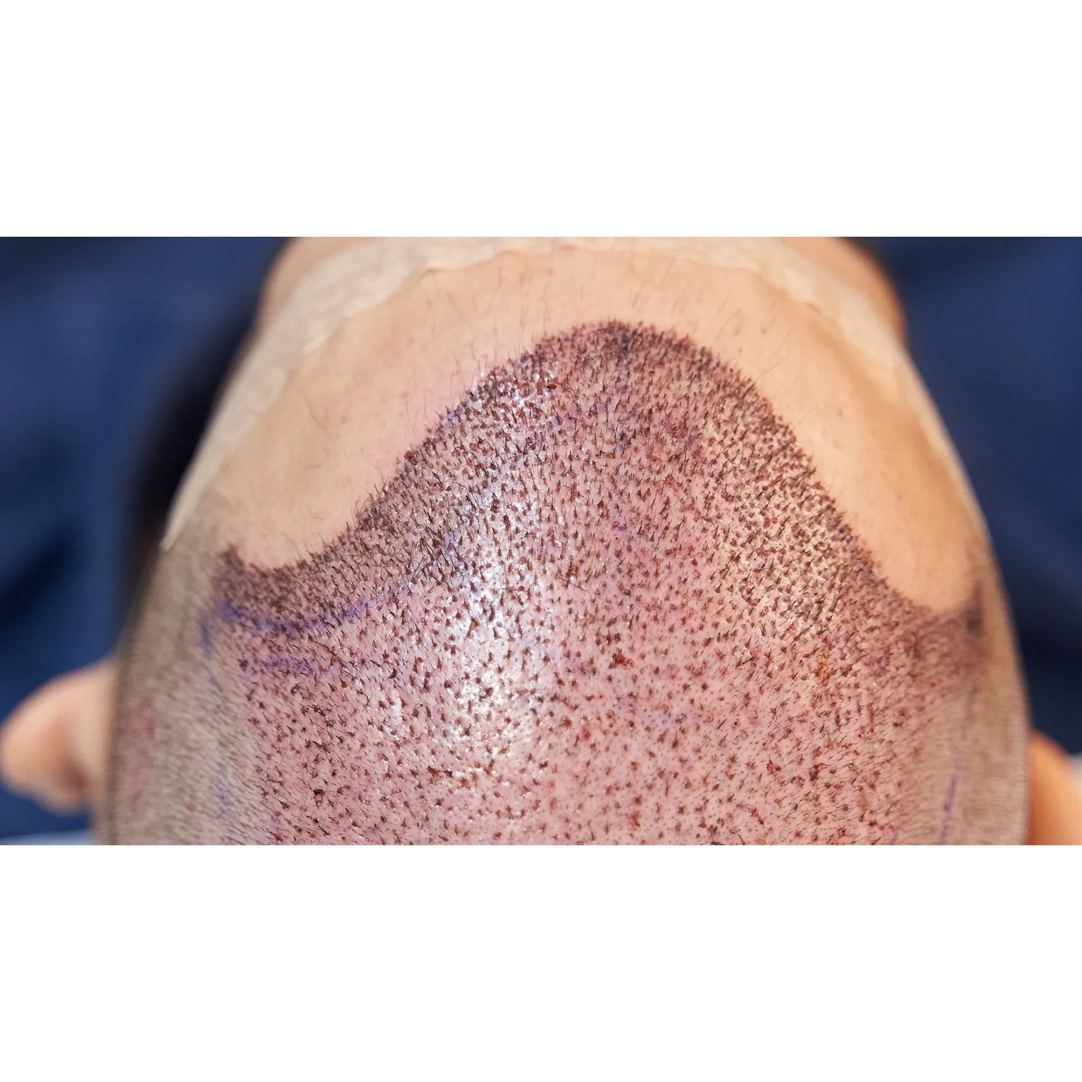 Affordable Hair Transplant Cost in Thane: Start... main image
