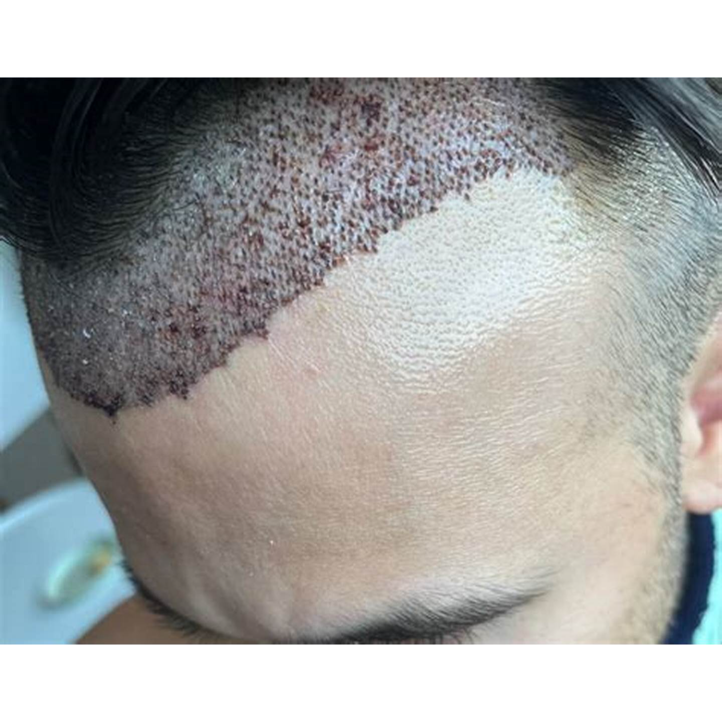 Why Choose a Board-Certified Dermatologist for ... main image