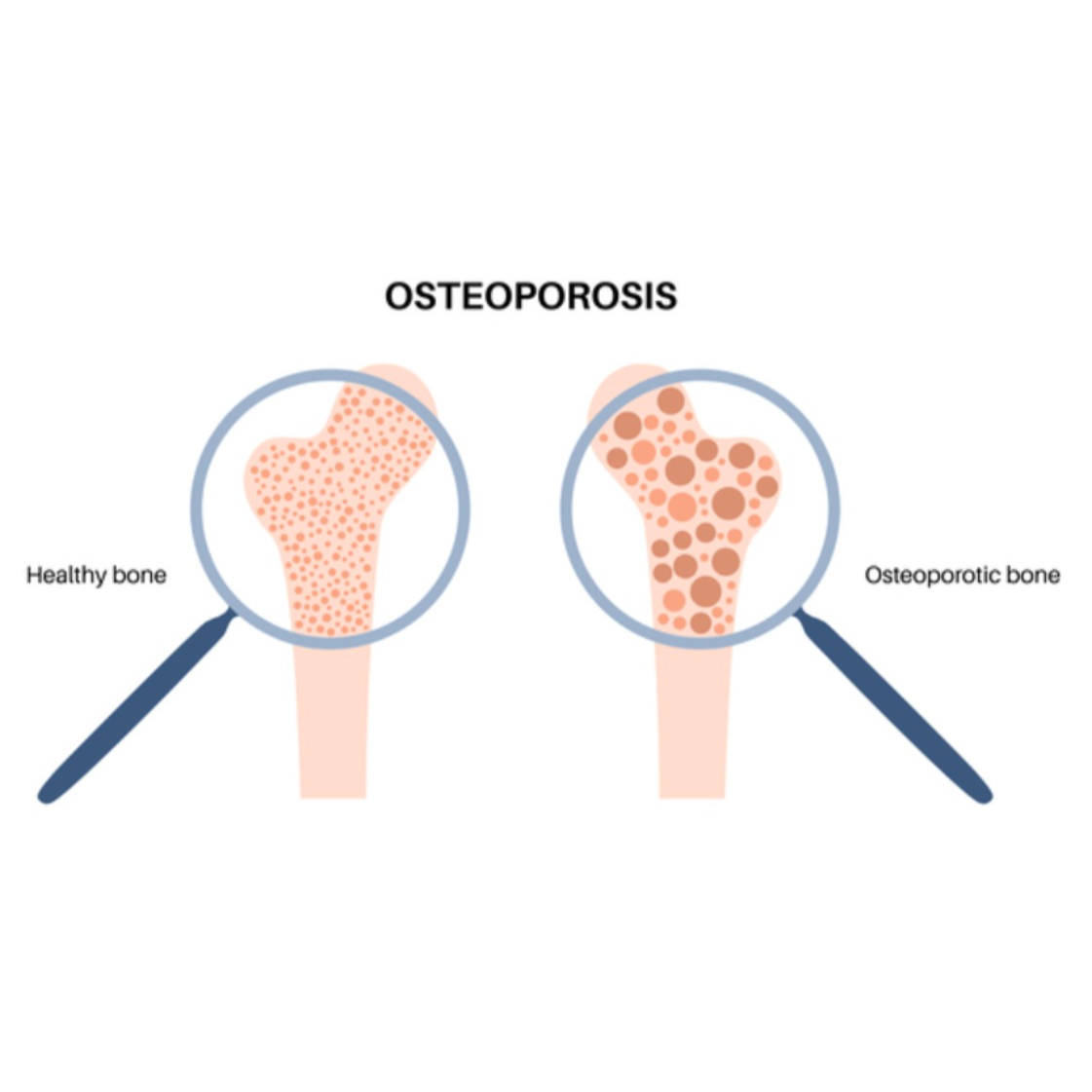 Osteoporotic Fracture Management with Vertebrop... main image
