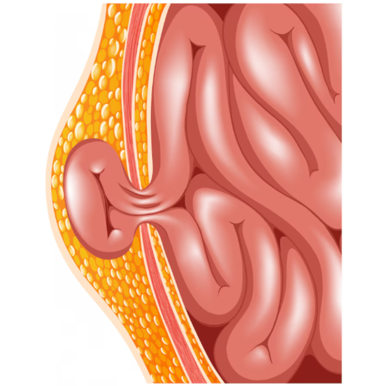 Hernia Treatment in Chennai – Expert Surgical S... main image