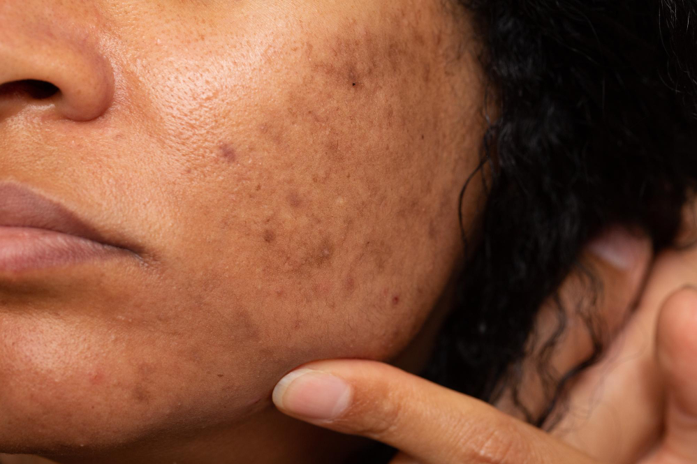 Ayurvedic Treatment for Pigmentation on Face in... main image