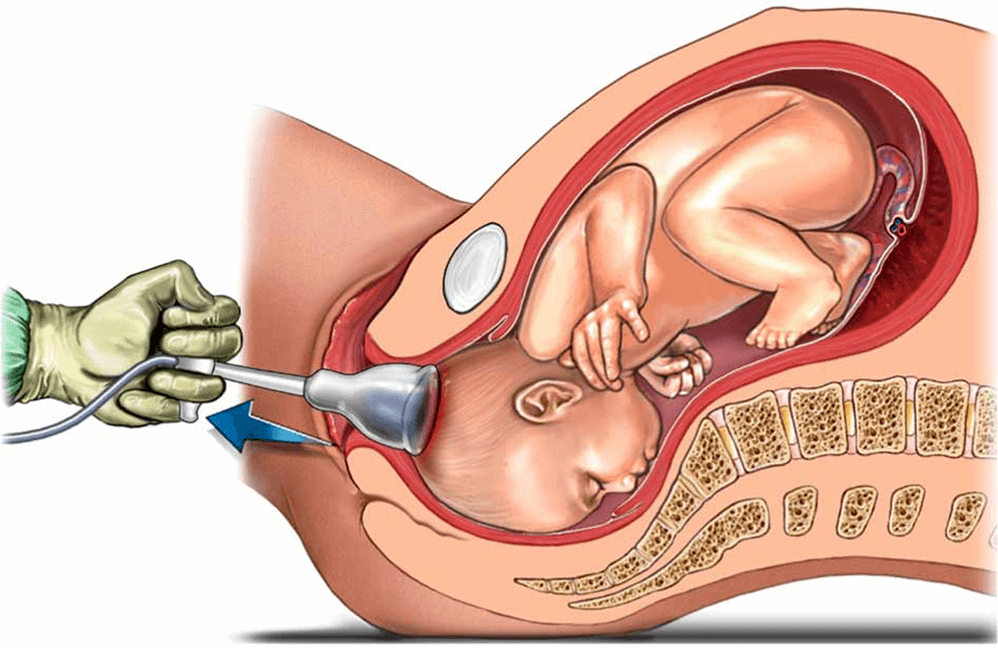Assisted Delivery in Nagpur: Expert Support Whe... main image