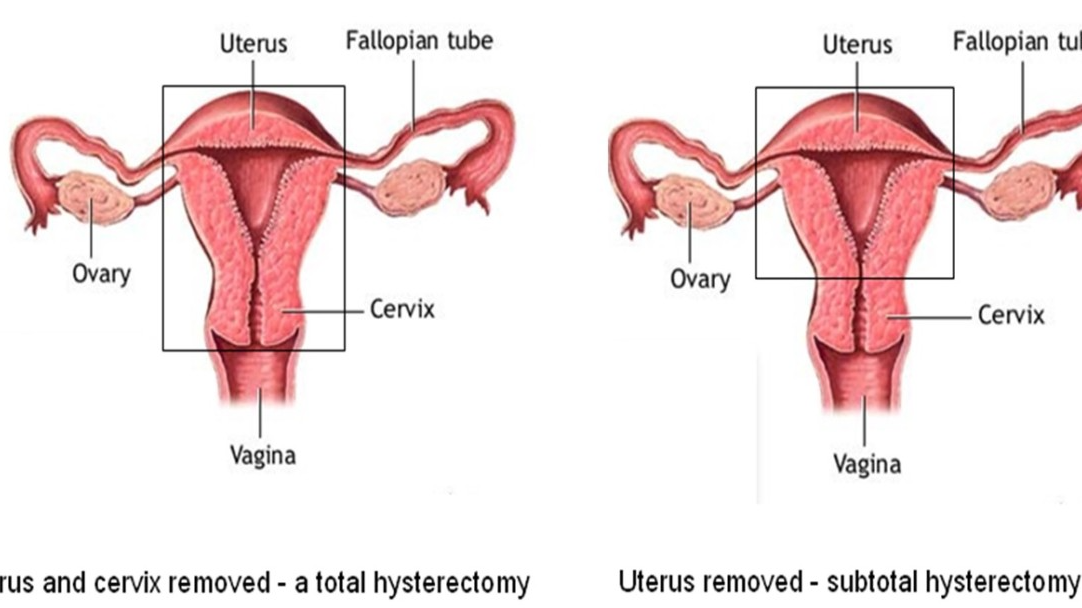 Hysterectomy Treatment in Nagpur: Advanced Gyna... main image