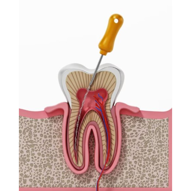 Best Root Canal Specialist in Nagpur – Protecti... main image