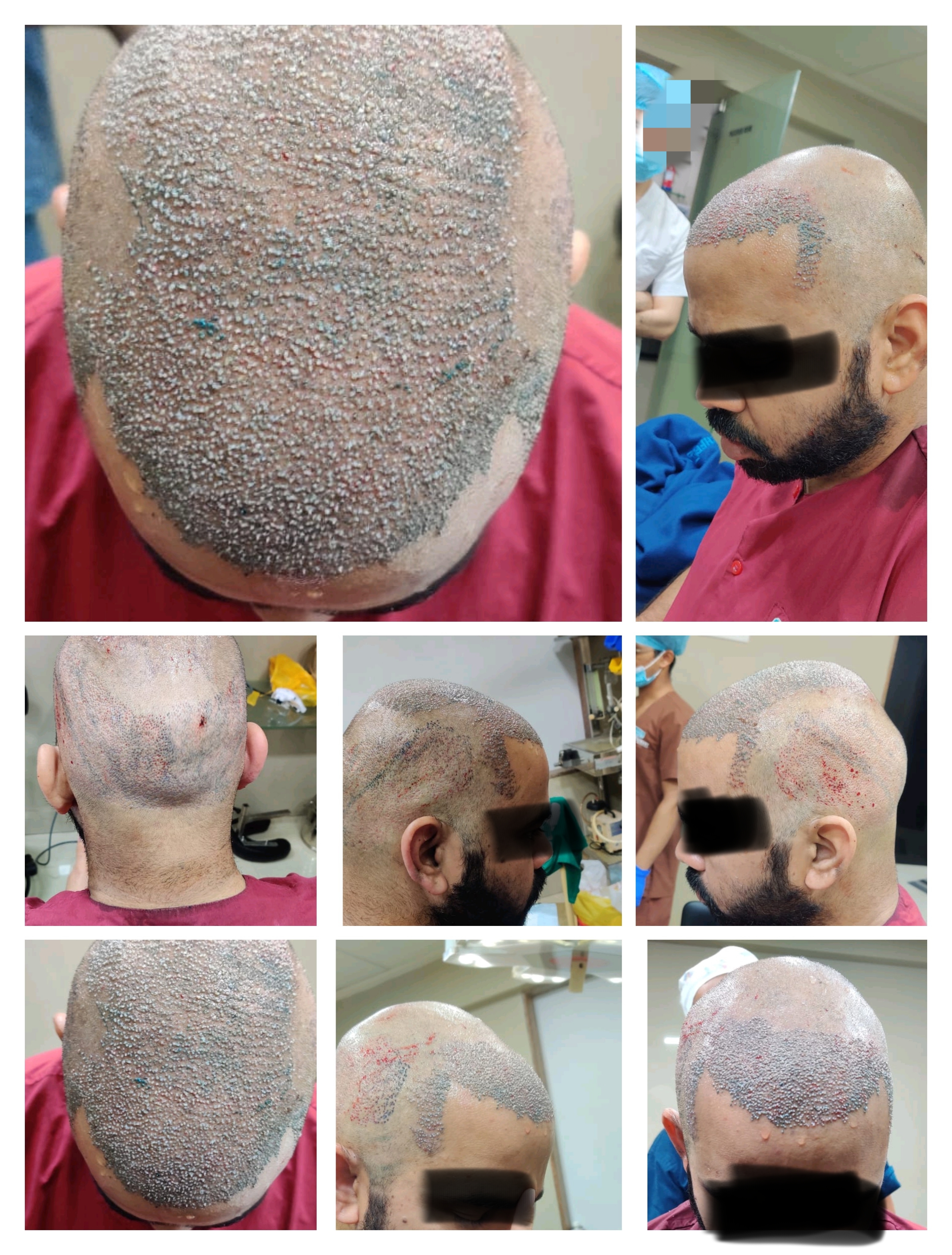 Hair transplant specialist in Mira Road East Th... main image