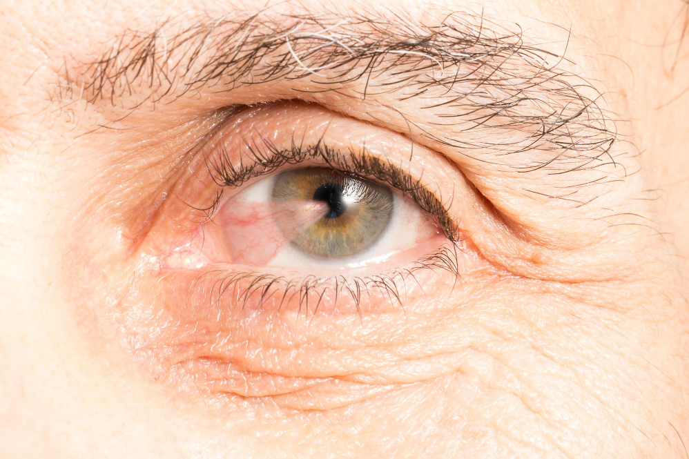 Pterygium Surgery in Nagpur – Restore Eye Healt... main image