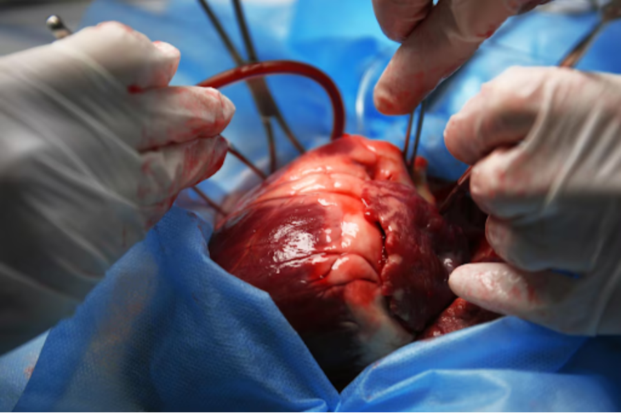OPCAB Surgery in Nagpur Off-Pump Coronary Arter... main image