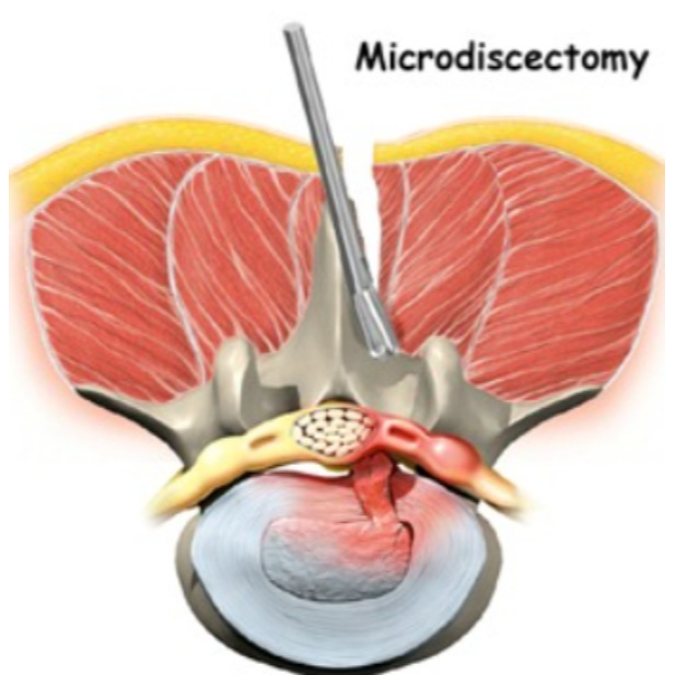 Microdiscectomy Surgery Center in Nagpur – Relief ... main image