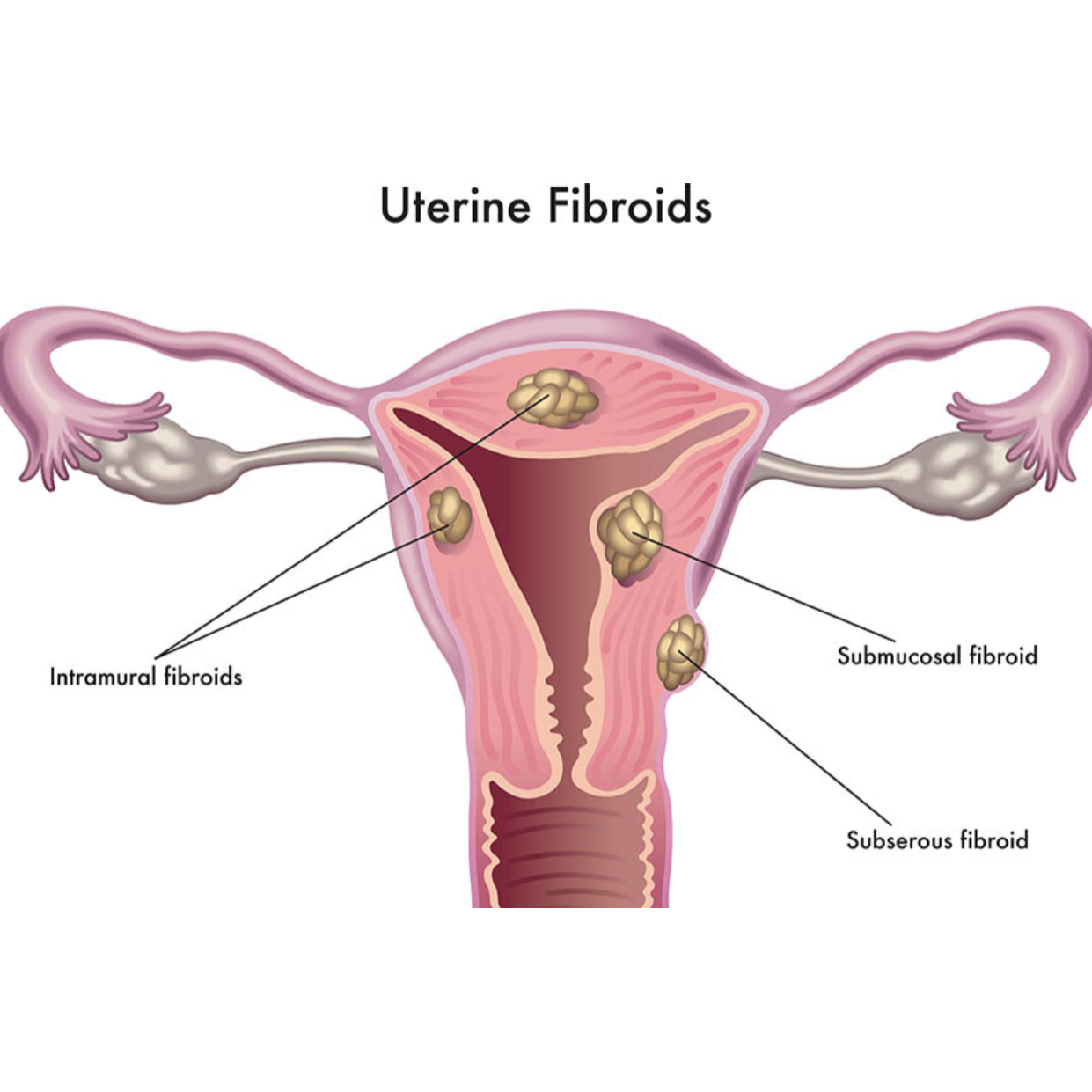 Fibroid Uterus Treatment in Nagpur: Comprehensive ... main image
