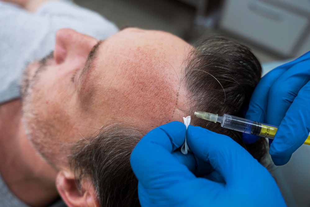 Hair Restoration in MRC Nagar – Effective and Mode... main image