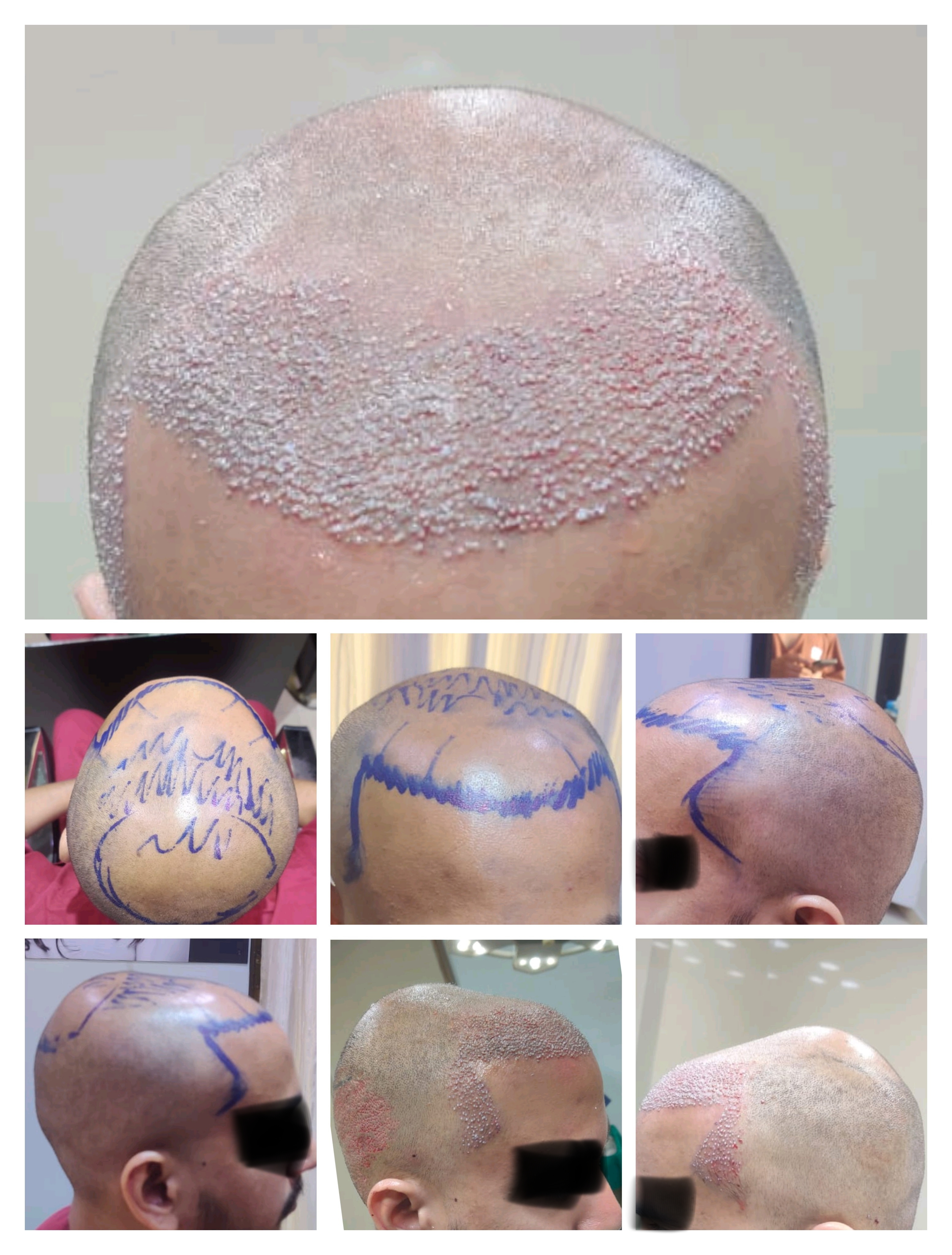 Hair surgeon in Mira Road Hair restoration surg... main image