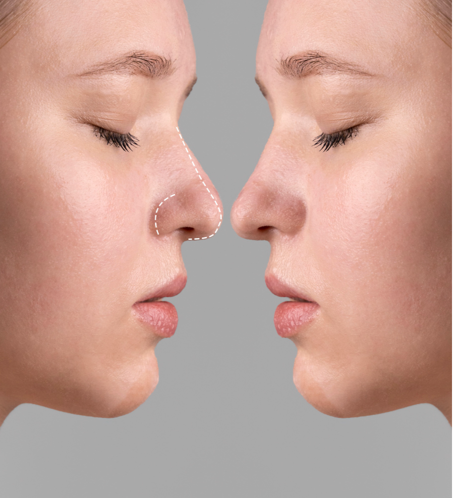 Rhinoplasty Surgery in Dwarka, Delhi: Functional a... main image