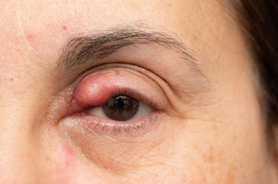 Dacryocystitis Management in Nagpur – Relieve E... main image
