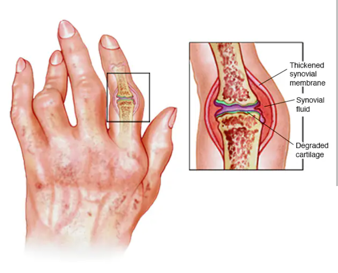 What is RHEUMATOID ARTHRITIS.. A chronic inflam... main image