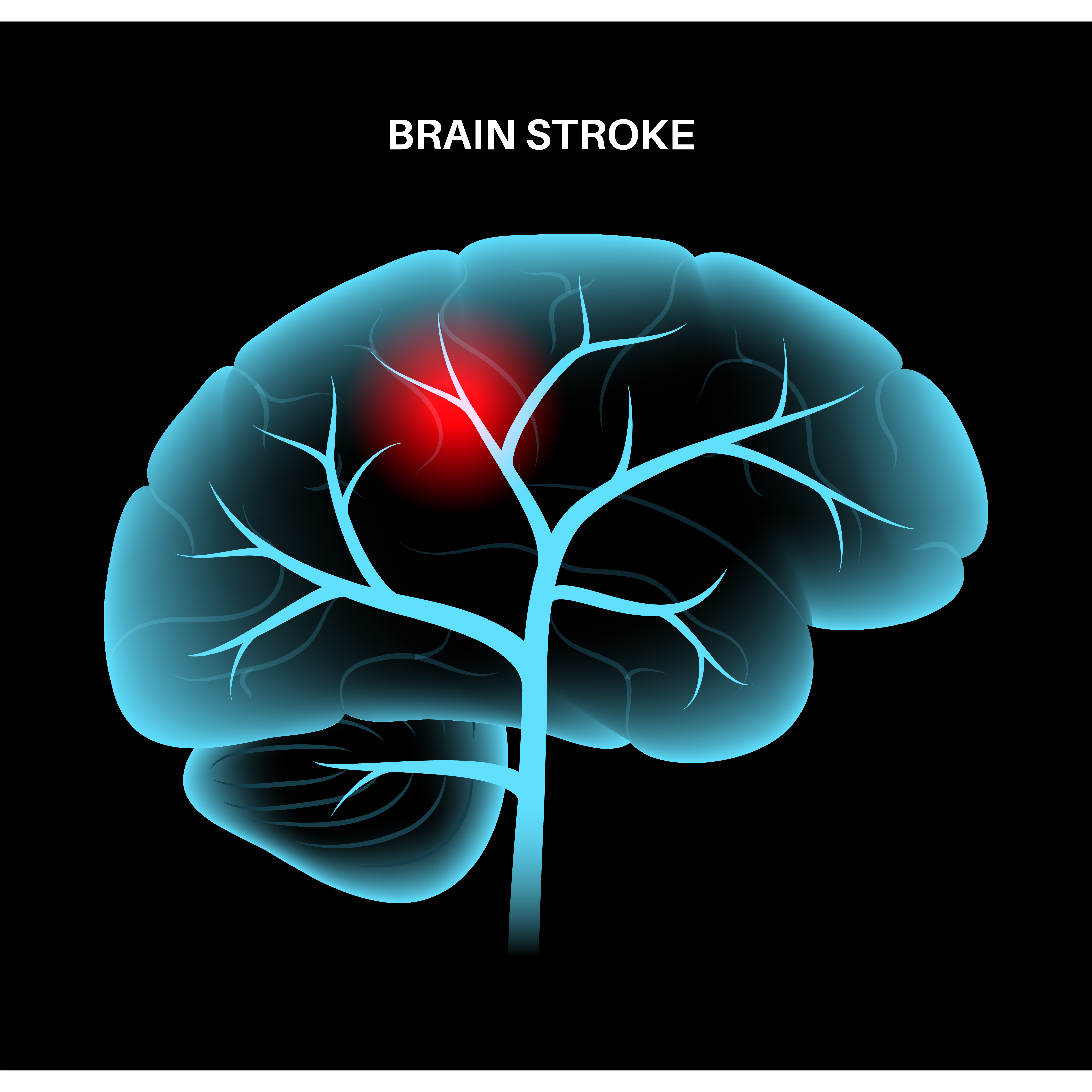 Stroke Treatment in Dombivli - Timely Action Saves... main image