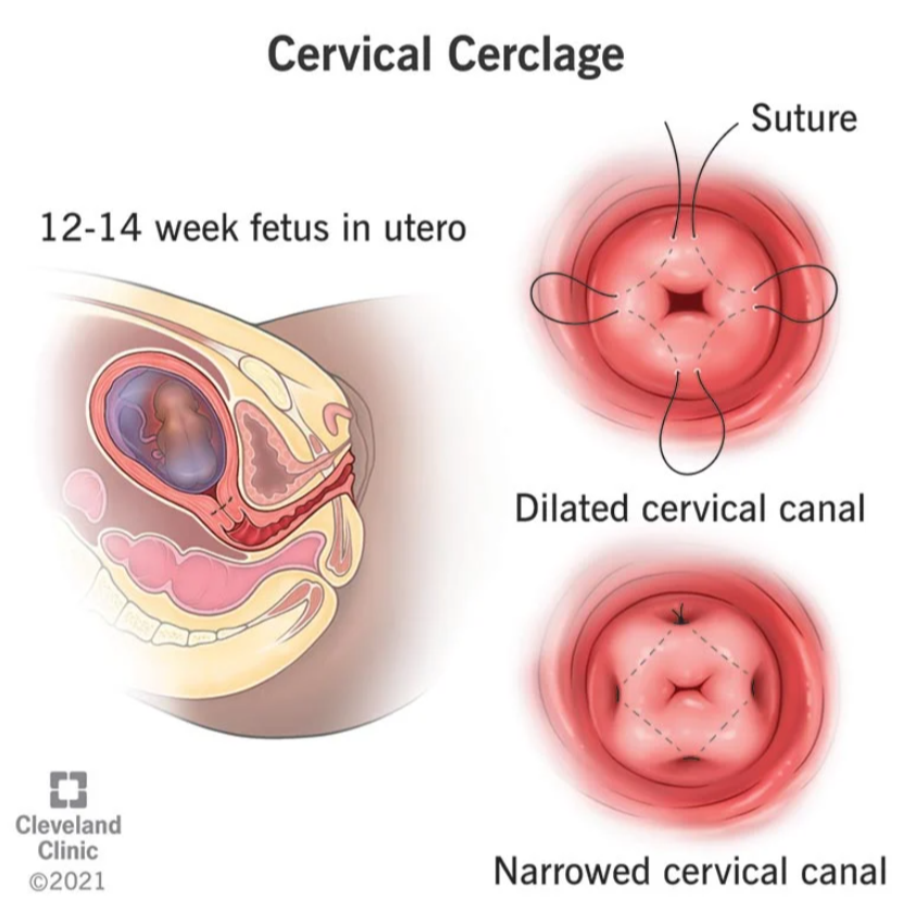 Cervical Cerclage in Nagpur: Specialist Care for P... main image