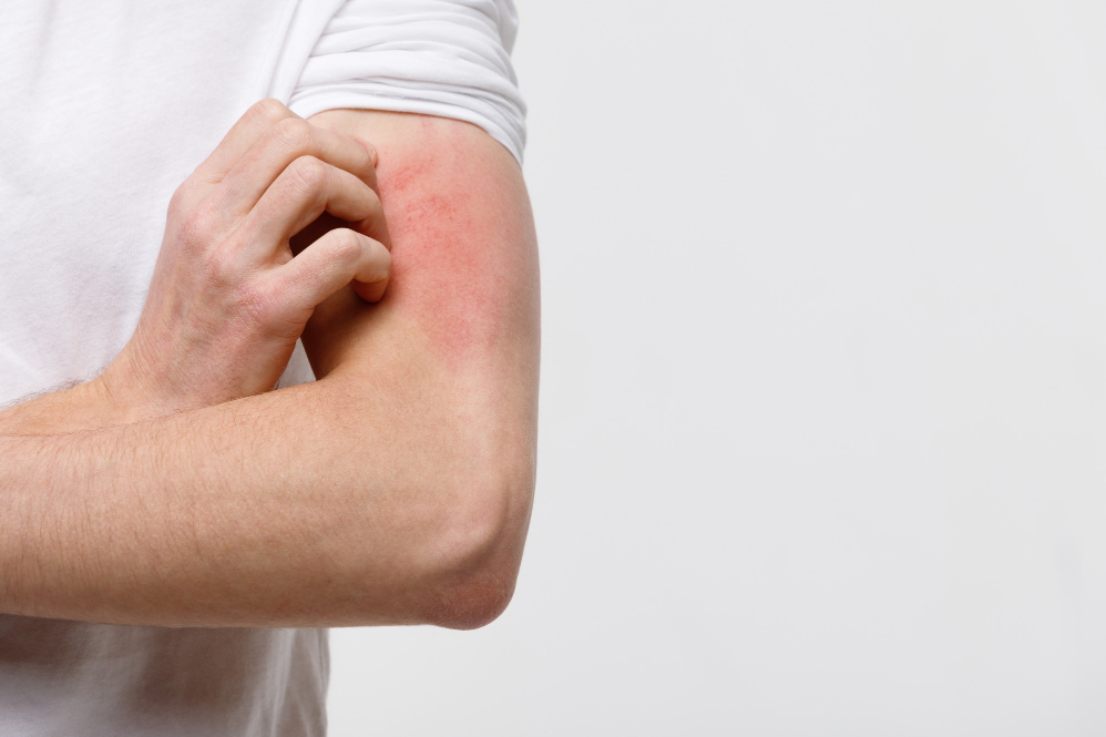 Best Ayurvedic Medicine for Skin Allergy in Pun... main image