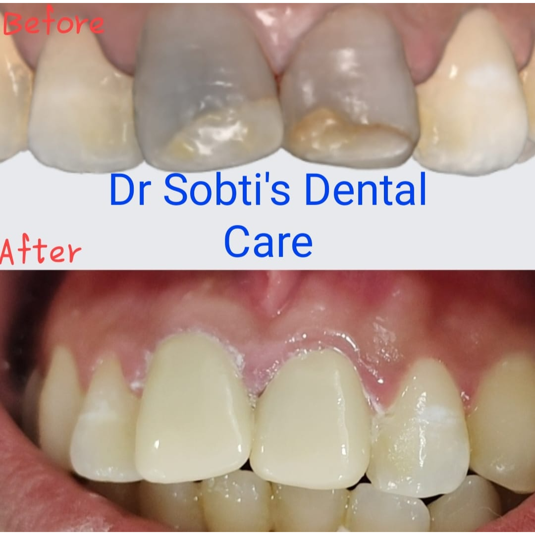 CROWNS IN A DAY is now a reality at Dr. Sobti’s... main image