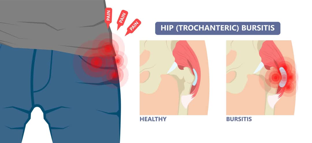 Hip bursitis comes in many forms as there are mult... main image
