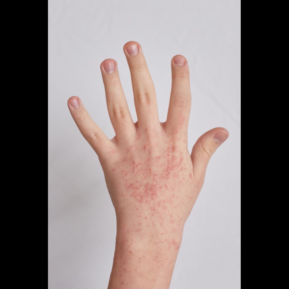 Ayurvedic Medicine for Eczema in Pune – Root-Le... main image