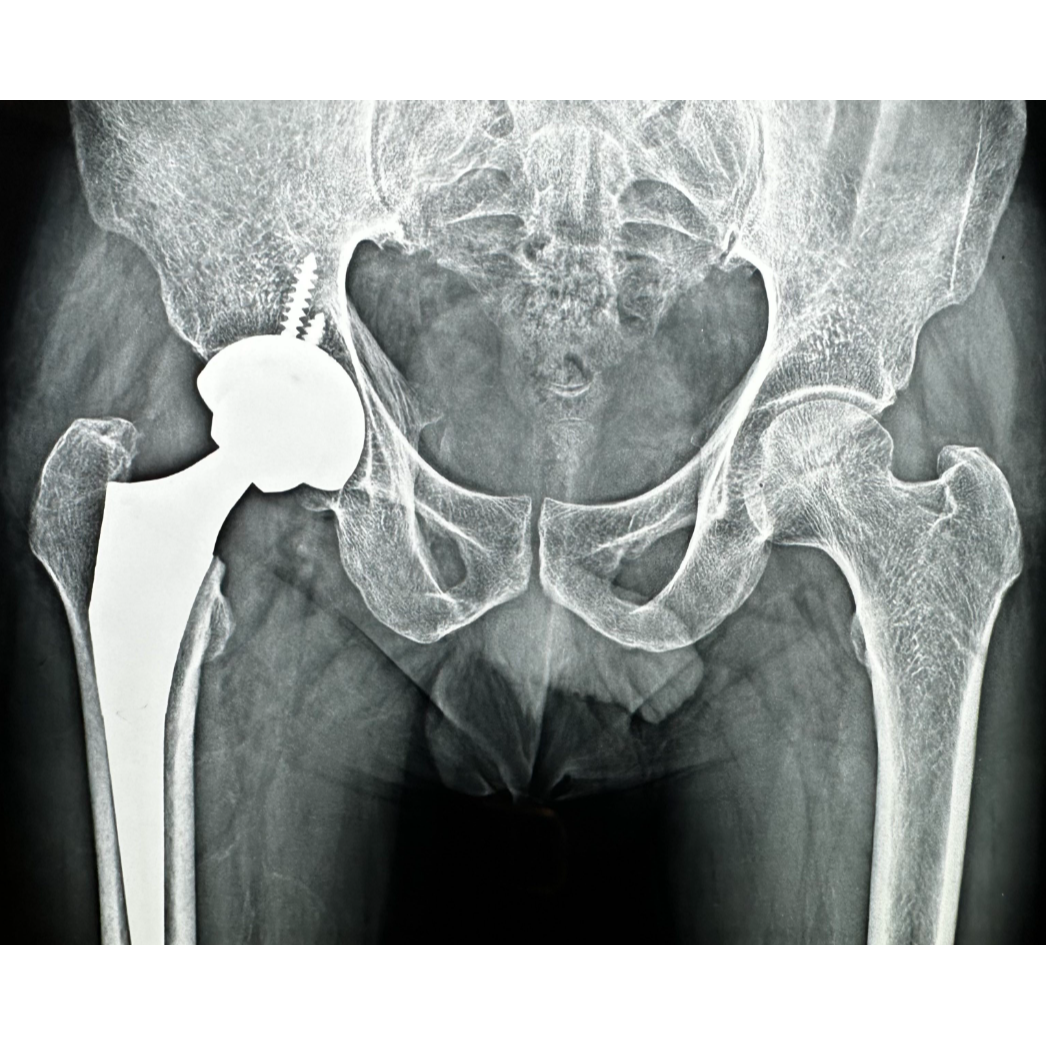 Hip Replacement Treatment in Nagpur – Regain Co... main image
