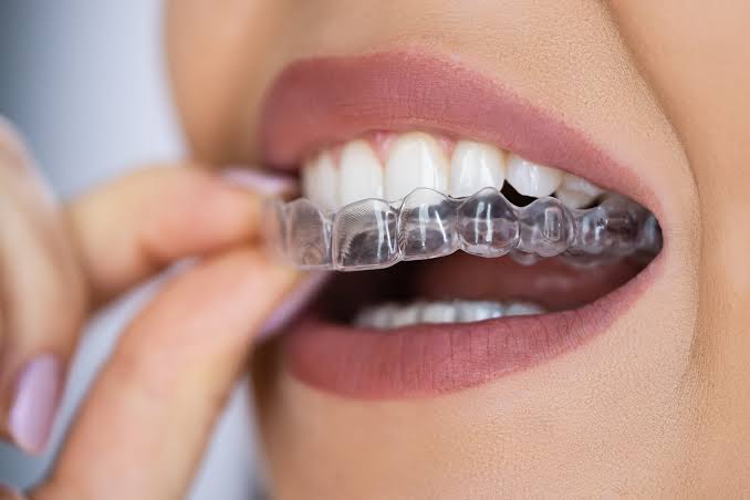 Dental Aligners in Mira Road– Invisible Solutio... main image