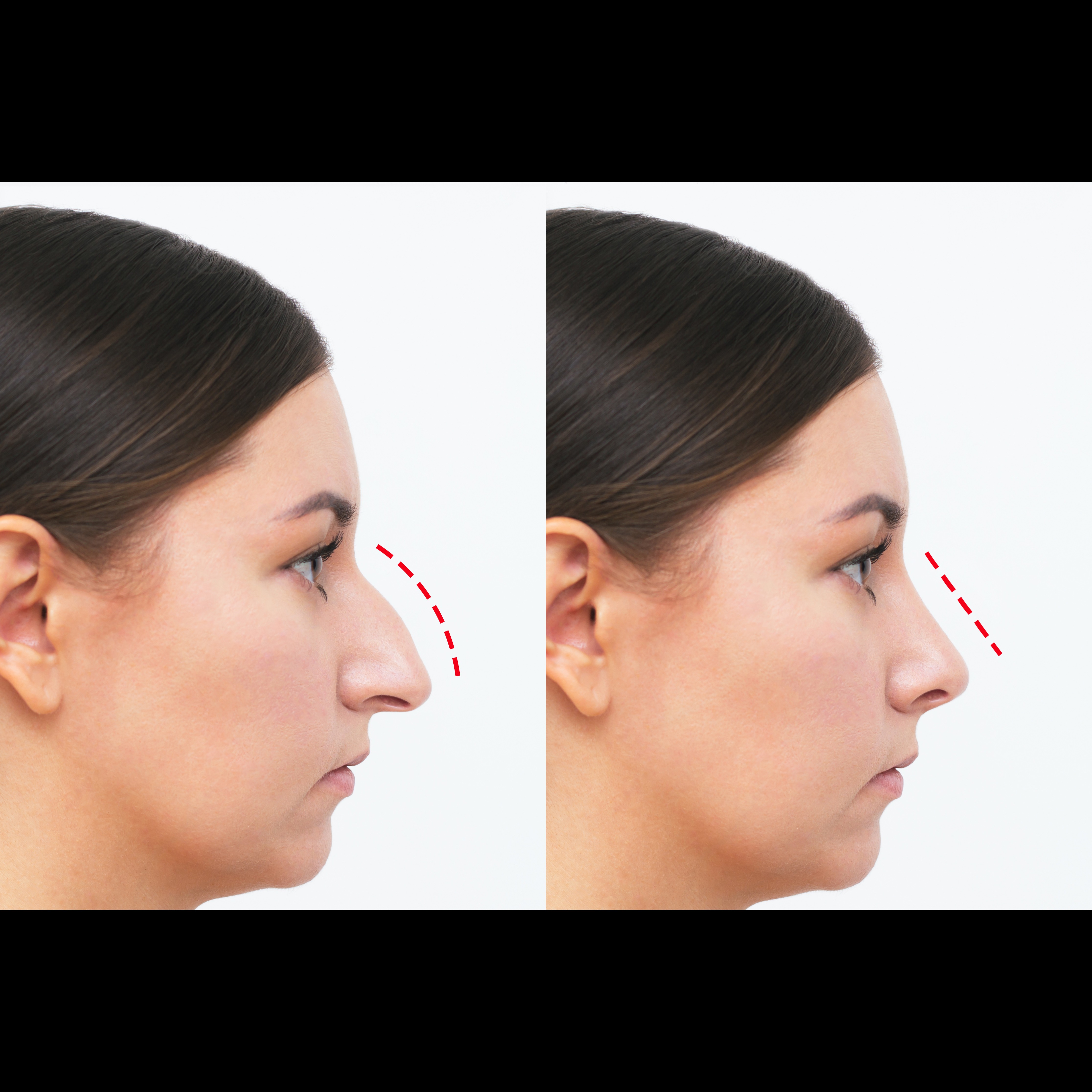 Septoplasty Surgery Cost in Jaipur: Affordable and... main image