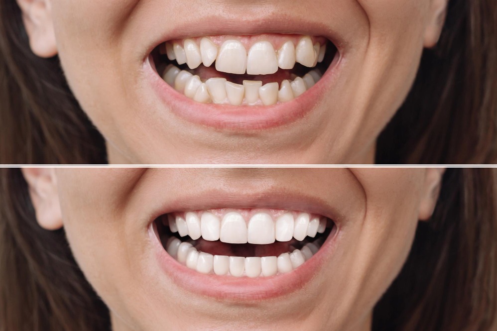 Teeth Alignment Treatment in Delhi – Straighten... main image