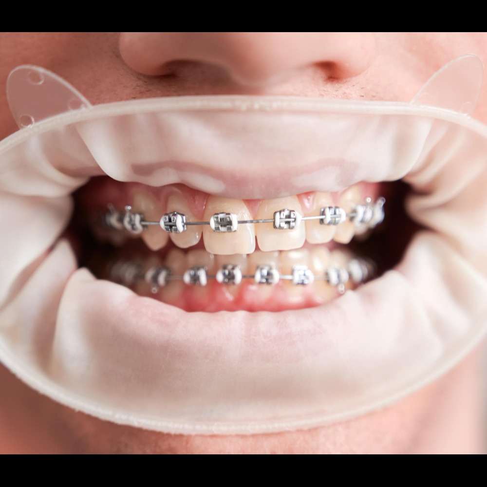 Braces – Trusted Orthodontic Treatment in Delhi fo... main image
