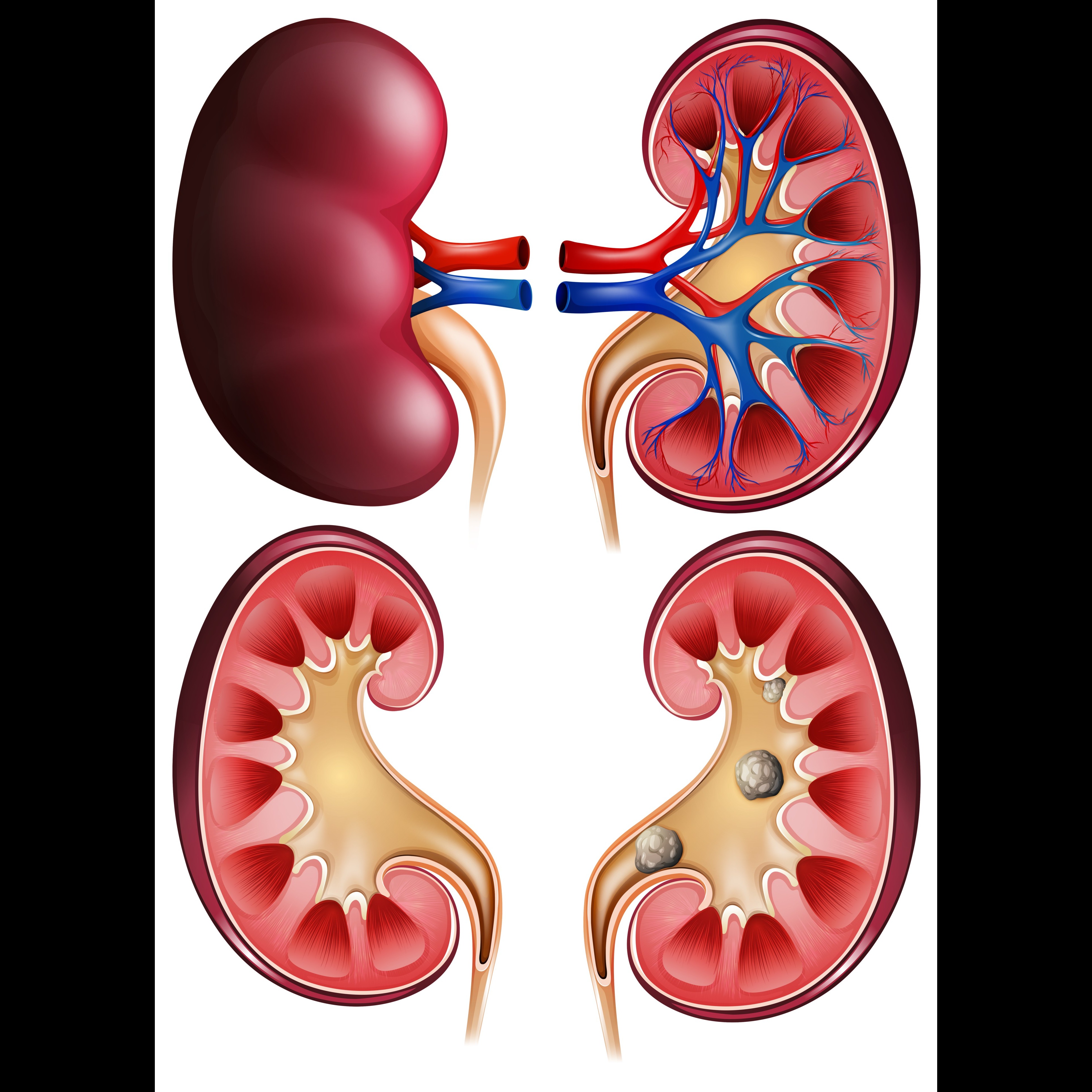 Kidney Stone Treatment Hospital in Pune Kidney ... main image