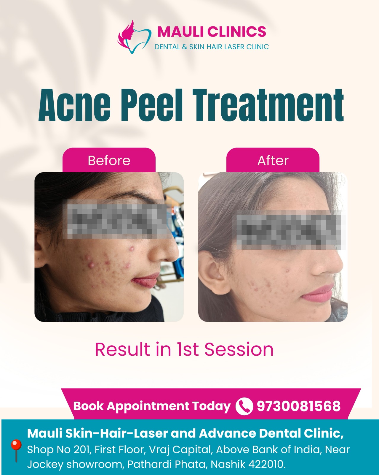 Best Acne Peel Treatment in Nasik . In chemical pe... main image