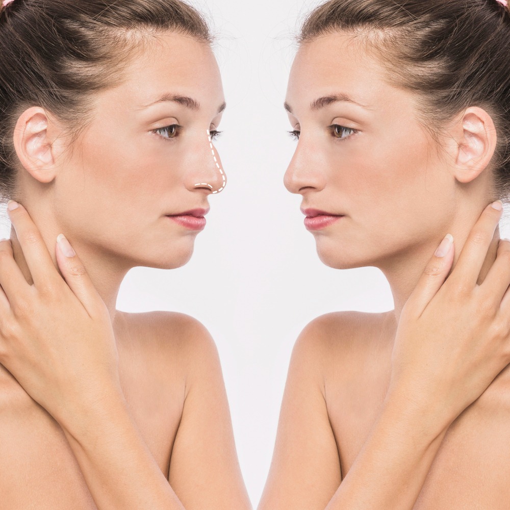 Septoplasty Surgery in Dwarka, Delhi: Relief from ... main image