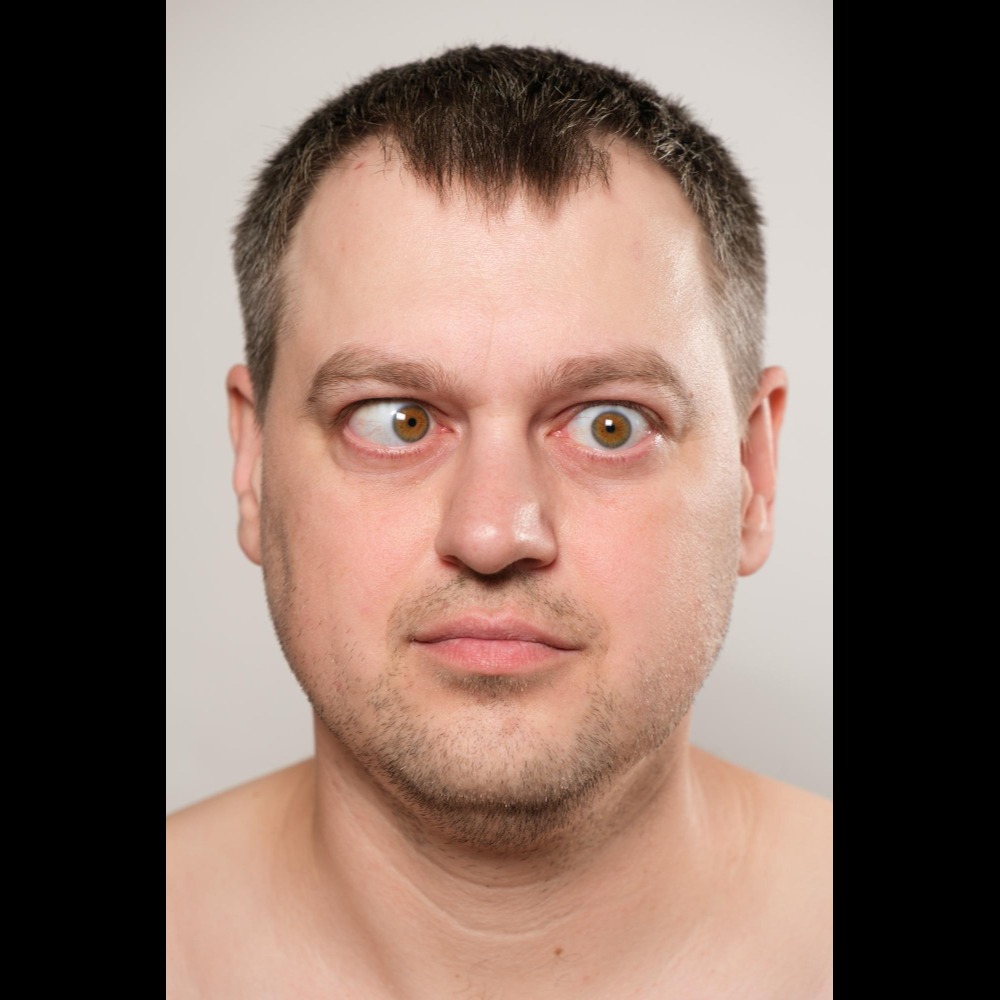 Squint Correction in Nagpur – Achieve Proper Ey... main image