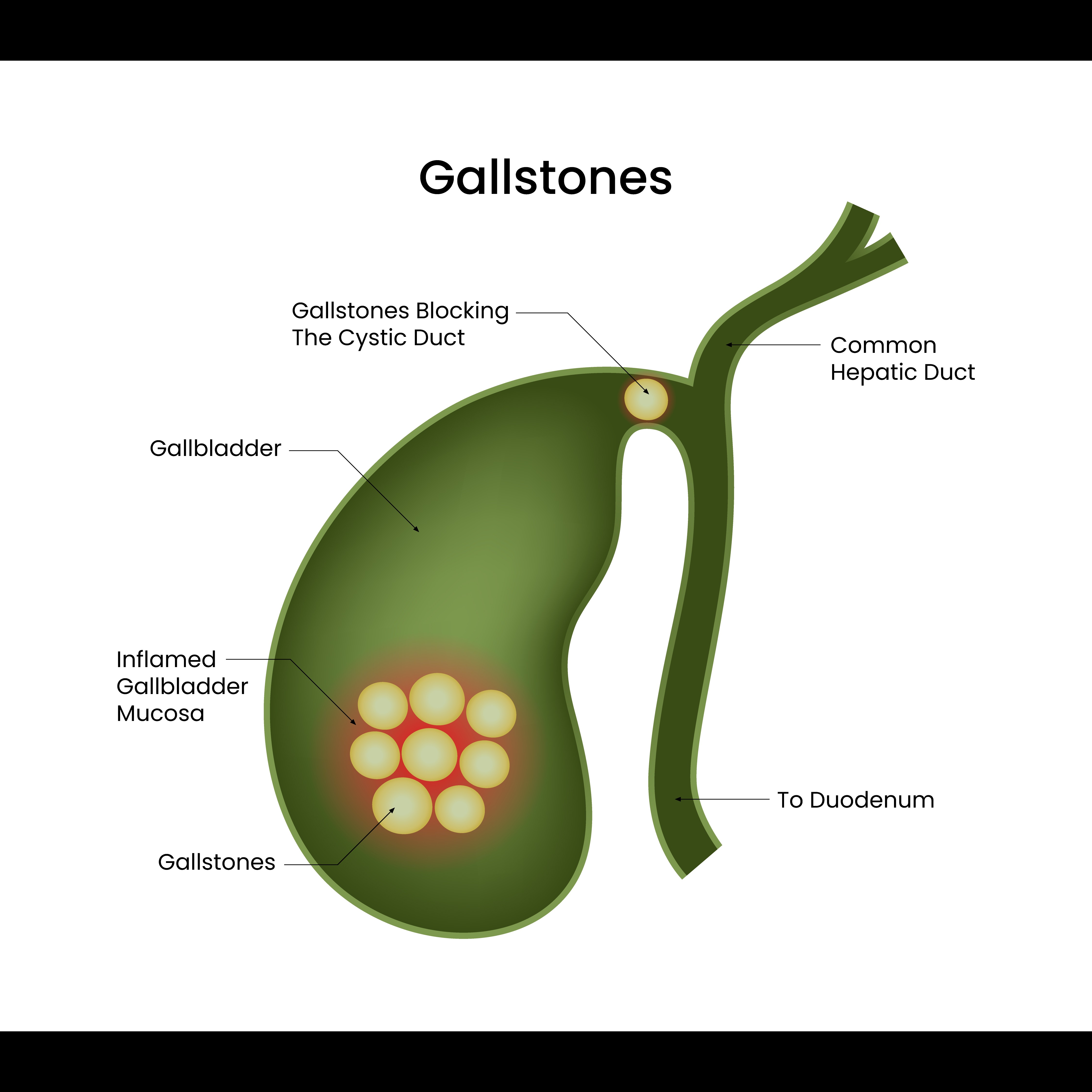 Gallbladder and Gallstone Treatment Hospital in... main image
