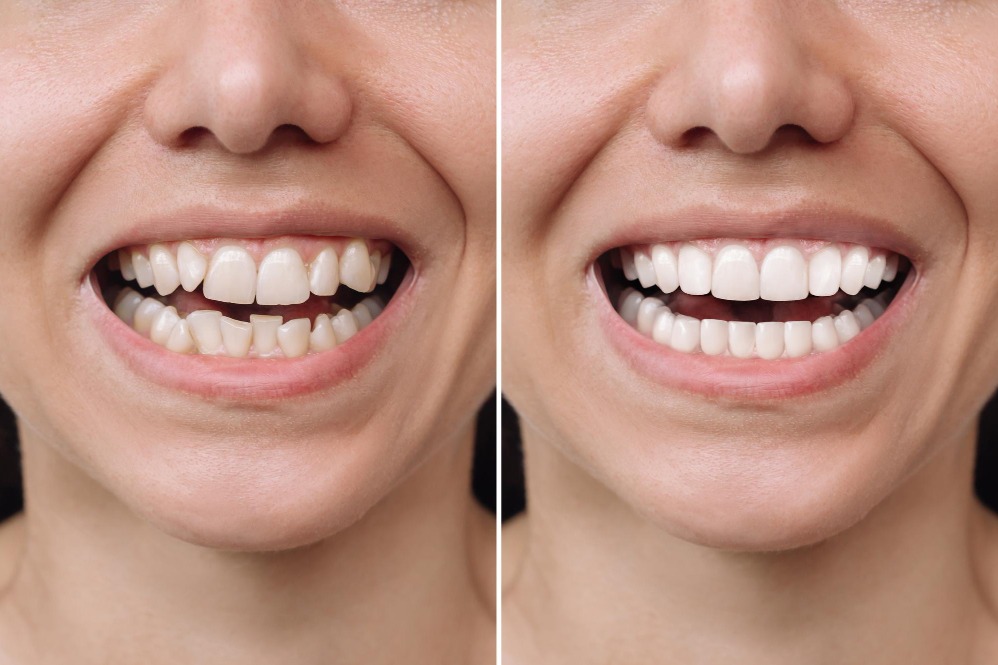 Tooth Contouring Treatment in Delhi – Reshape Your... main image