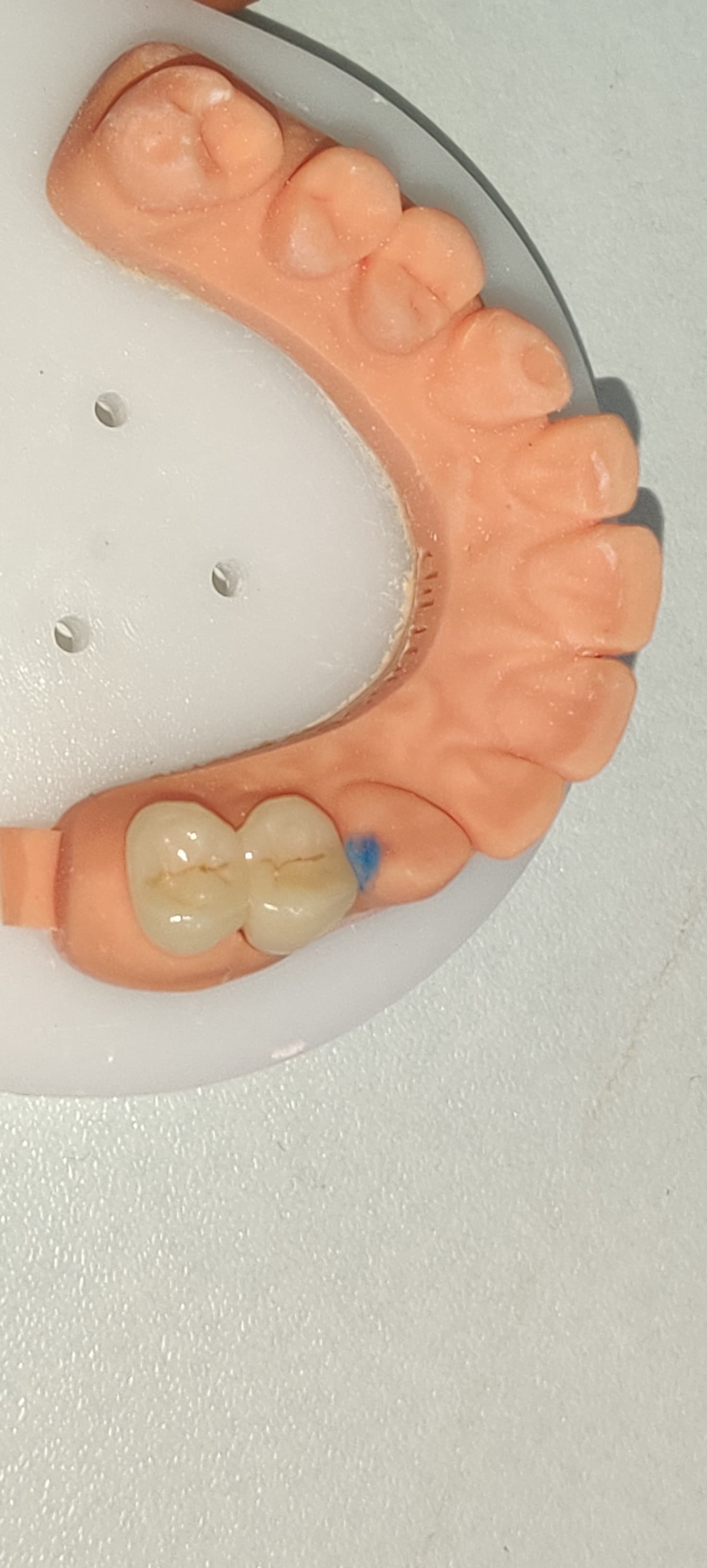 Dental cap in Mira Road Tooth colored bridge an... main image