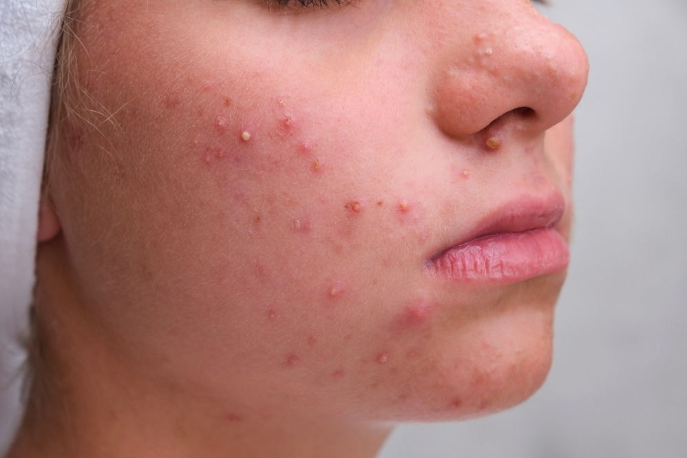 Ayurvedic Medicine for Pimples in Pune – Herbal... main image