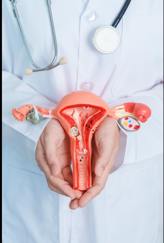 PCOS and Irregular Periods Treatment in Chennai – ... main image
