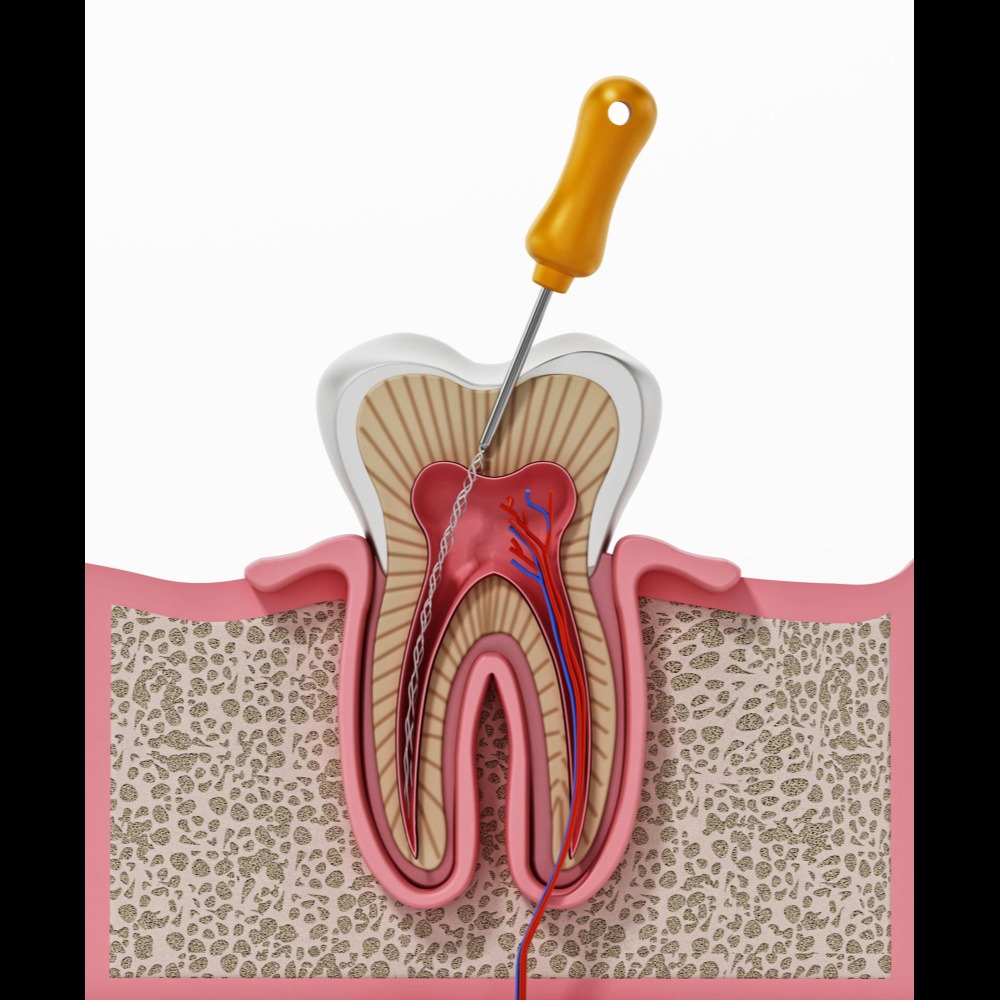 Experienced Root Canal Specialist in Nagpur Off... main image