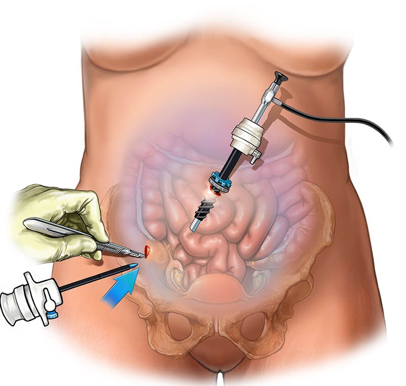 Affordable laparoscopic surgery in Dombivli

Exper... main image
