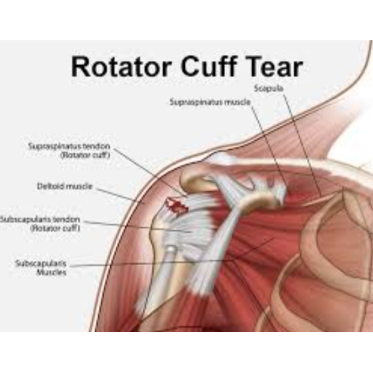 Rotator Cuff Tear Treatment in Nagpur – Special... main image