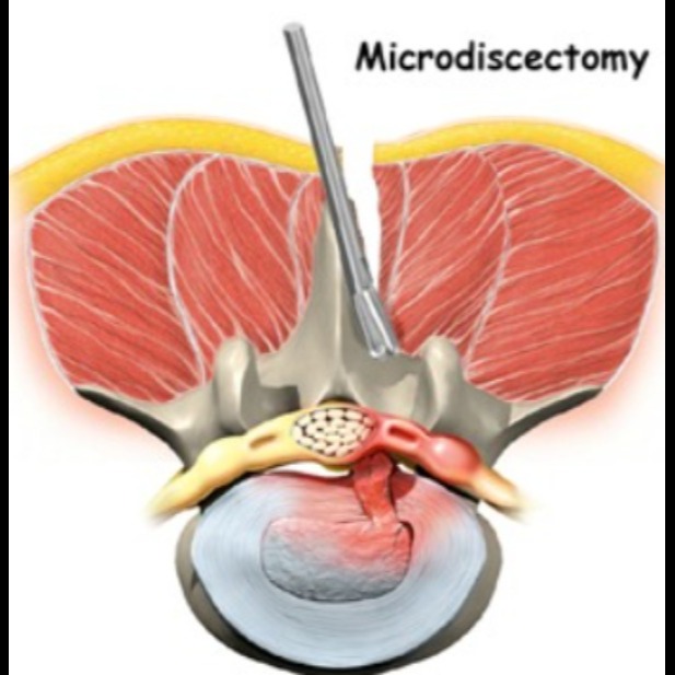 Microdiscectomy Surgery in Nagpur – Precision T... main image