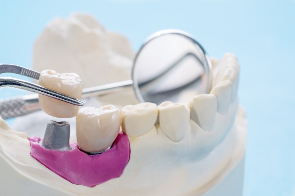 Dental Caps in Delhi – Strong Support for Damaged ... main image